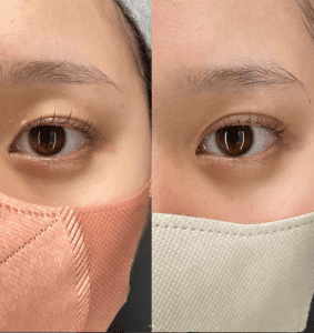 二重埋没法(裏留め)B TWICEの症例写真