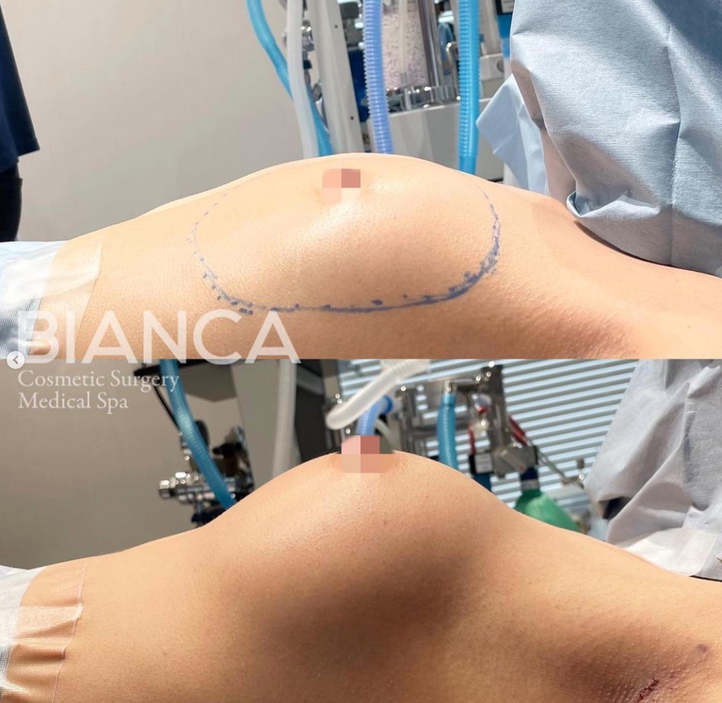 シリコンインプラント豊胸（シリコンバッグ豊胸）