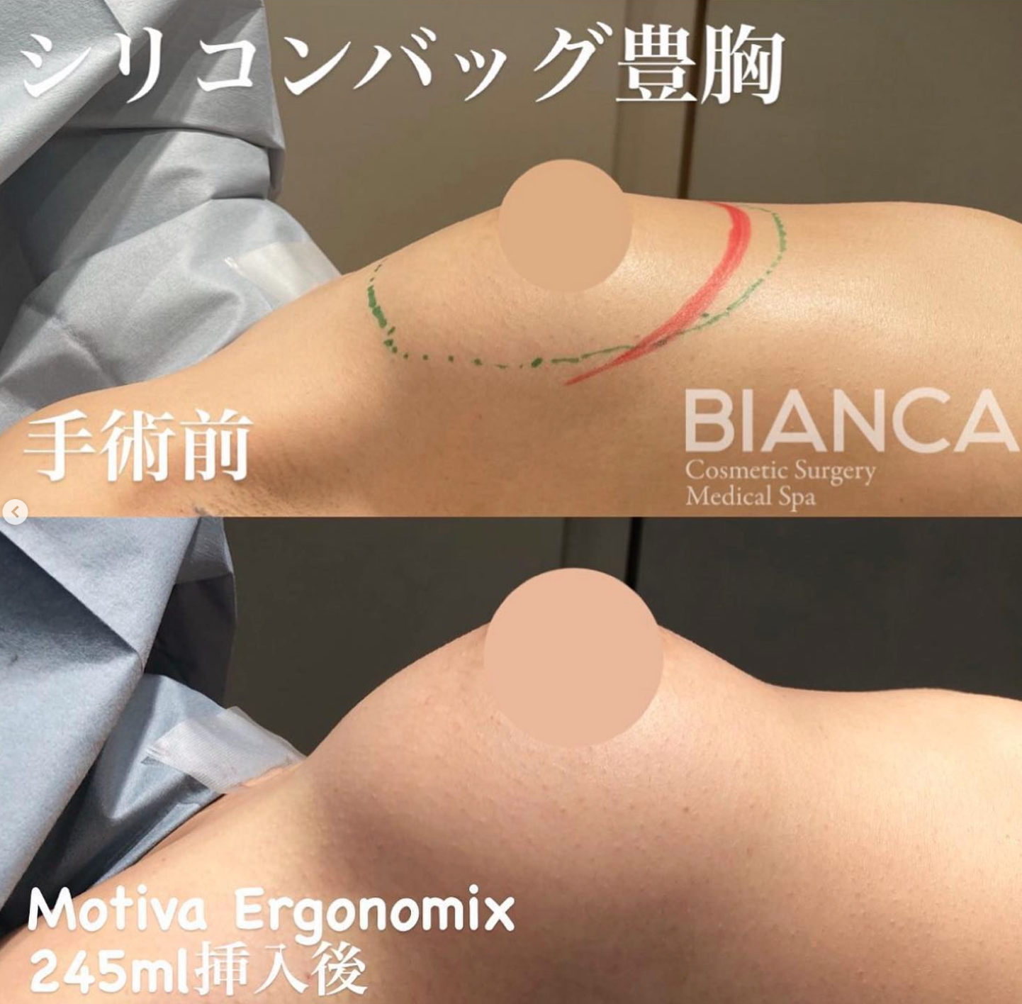 シリコンインプラント豊胸（シリコンバッグ豊胸）