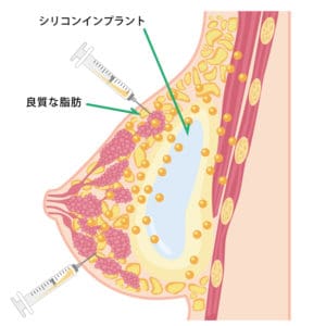 ハイブリッド豊胸（シリコンインプラント＋CRF）ビアンカ銀座｜日本を代表する美容健康再生医療のクリニック