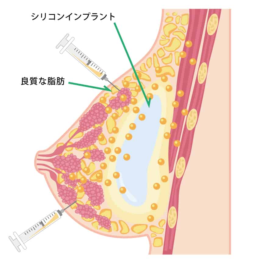 ハイブリッド豊胸（シリコンインプラント＋CRF）