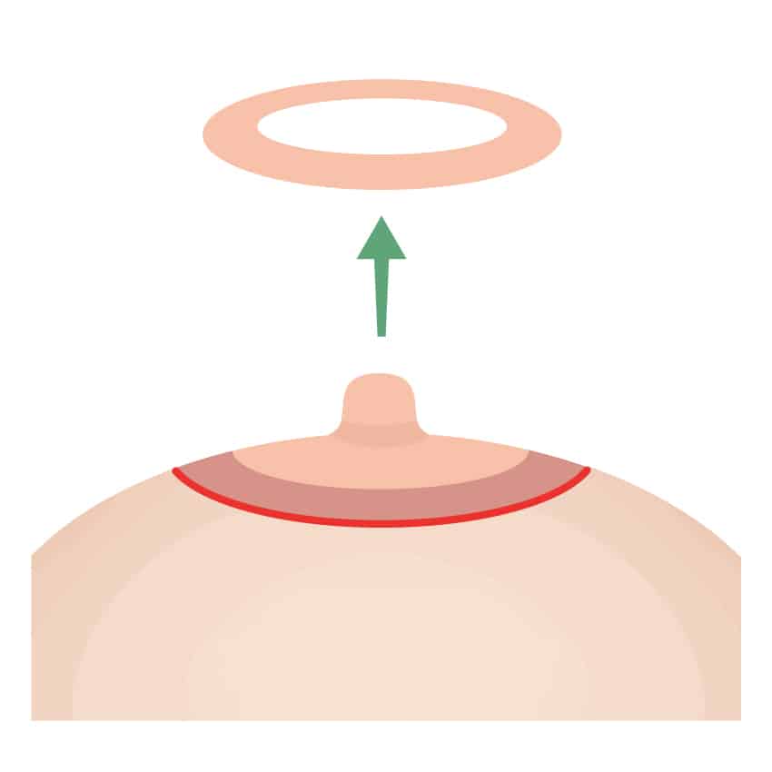 乳輪縮小 ビアンカ銀座｜日本を代表する美容健康再生医療のクリニック