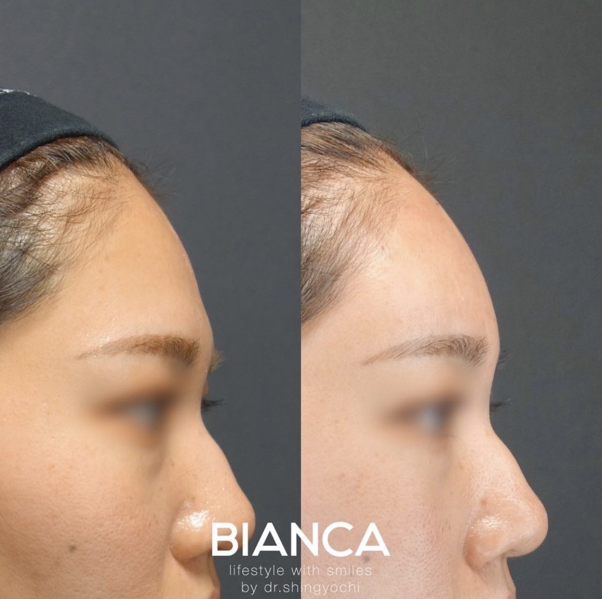 額ヒアルロン酸注入