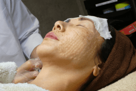 肌細胞移植（1回目）