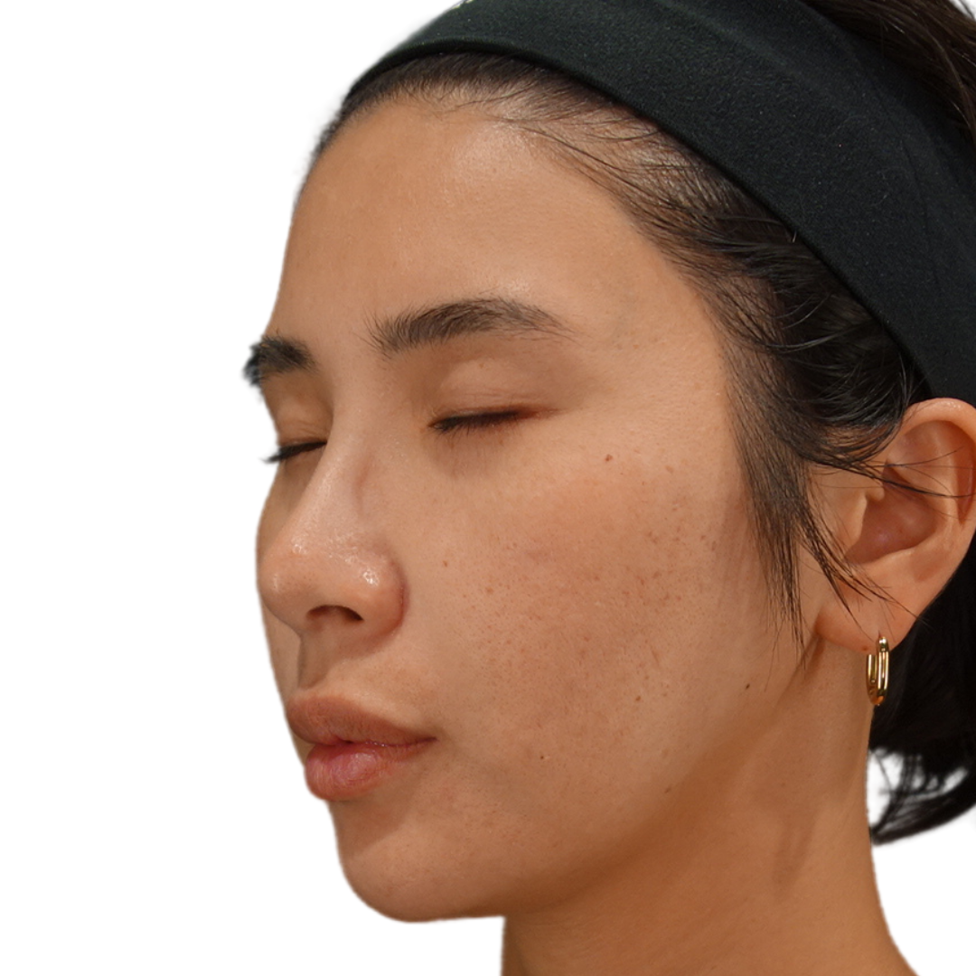 TCAクロス（クレーター治療）