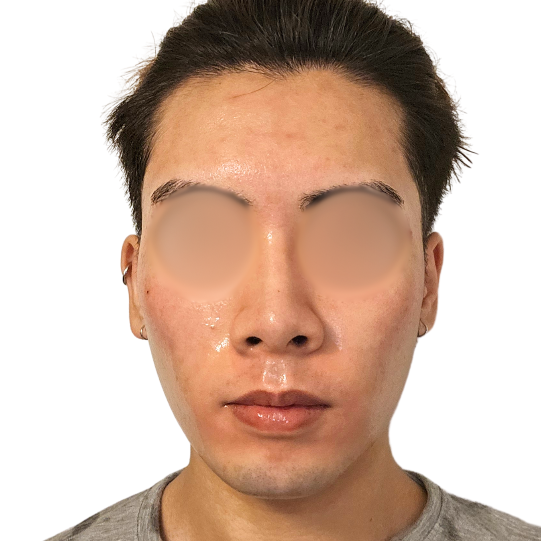 スキンボトックス