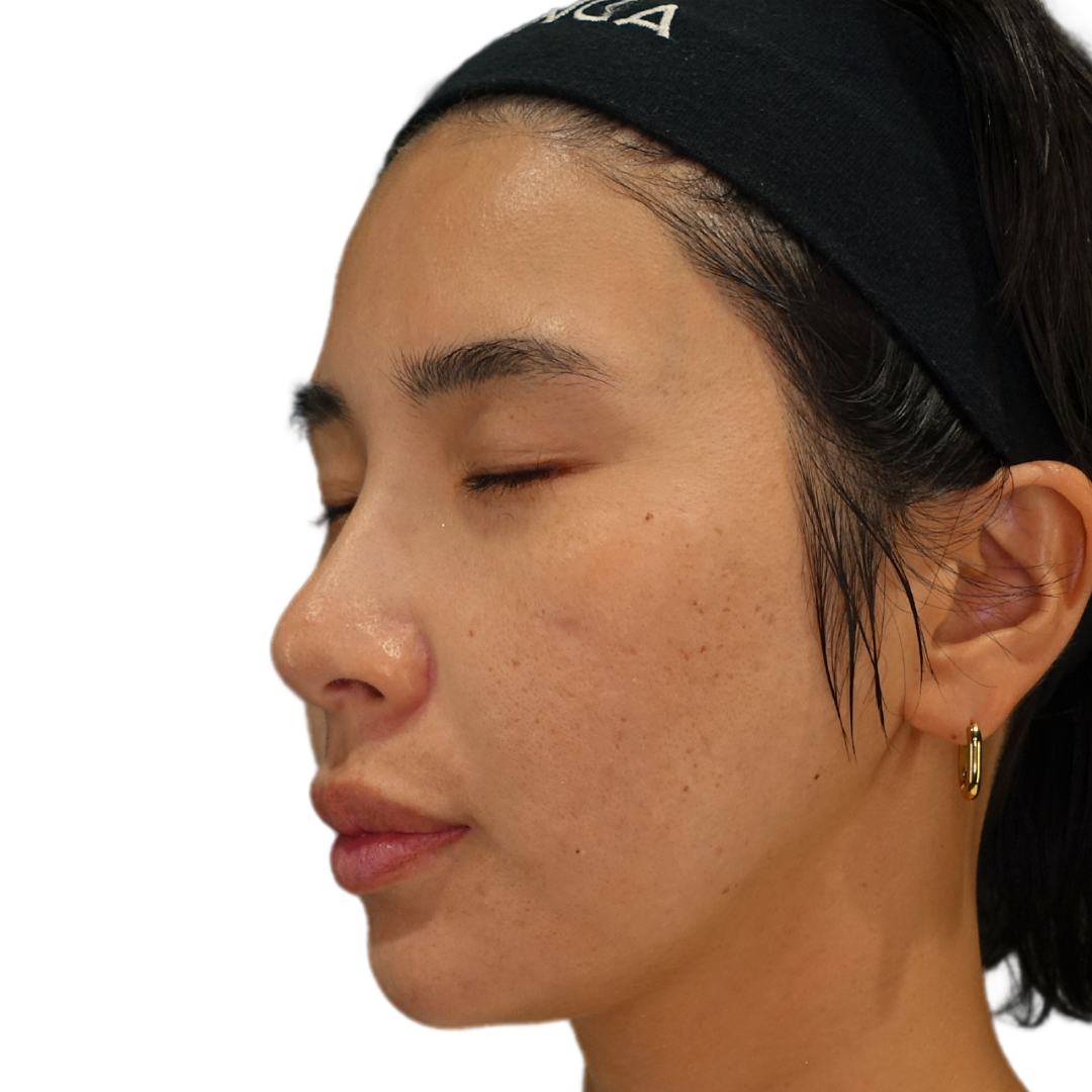 TCAクロス（クレーター治療）