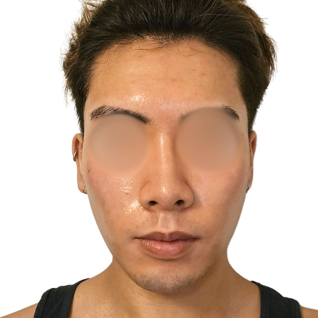 スキンボトックス