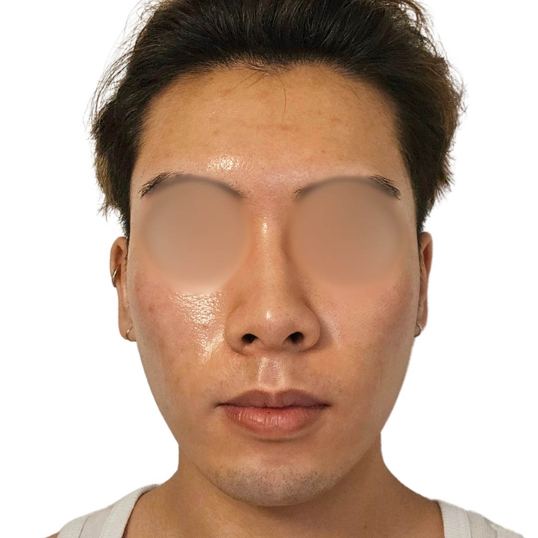 スキンボトックス