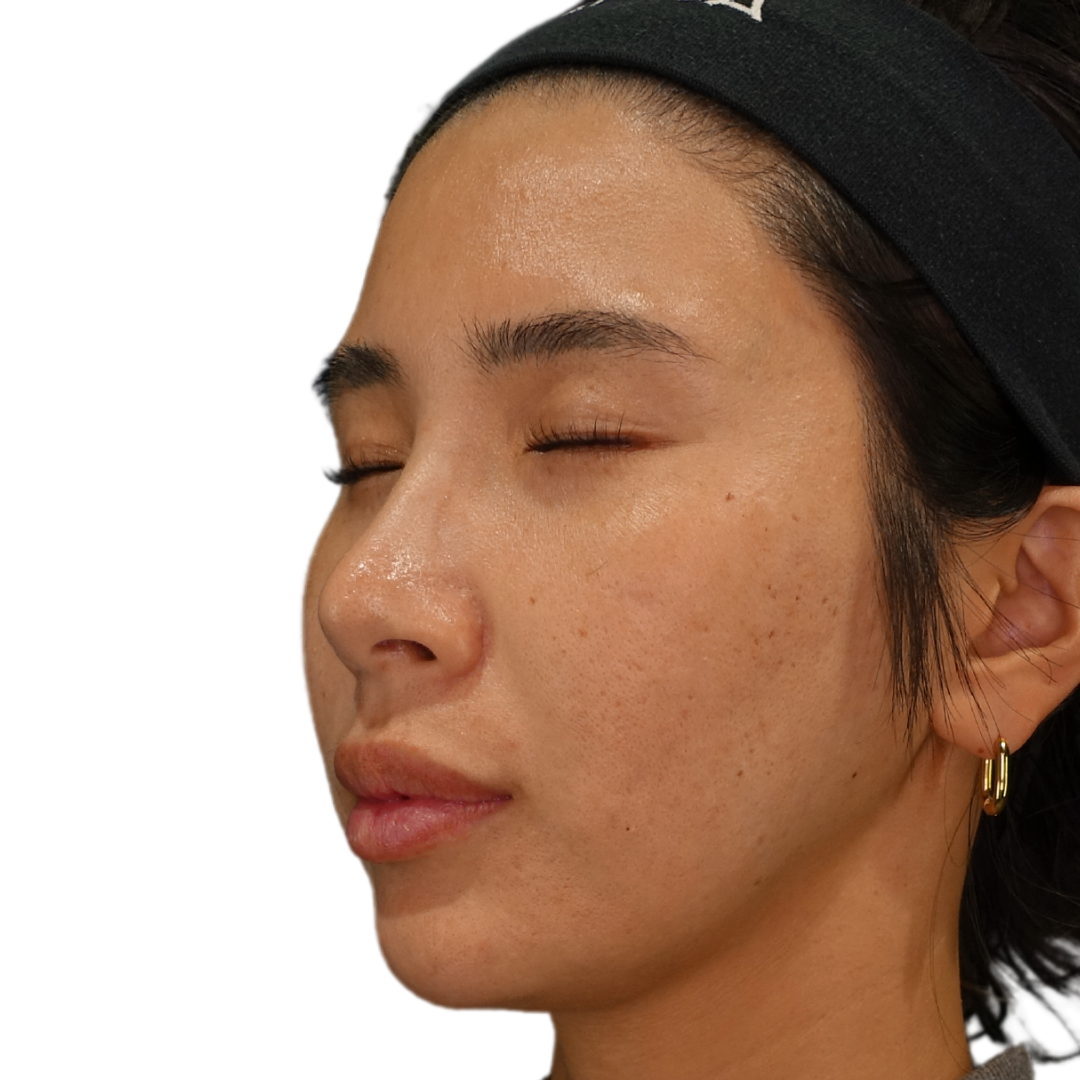 TCAクロス（クレーター治療）