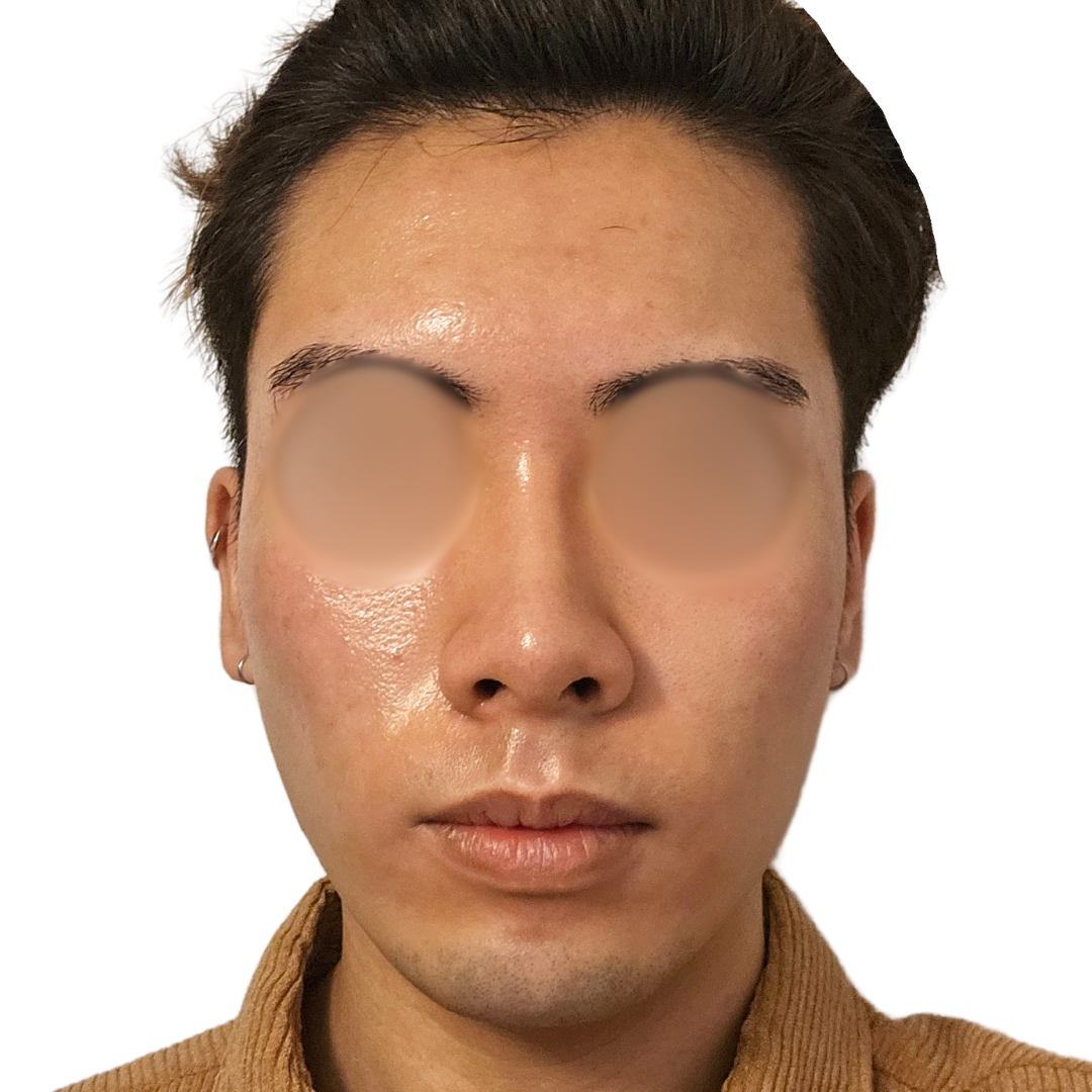 スキンボトックス