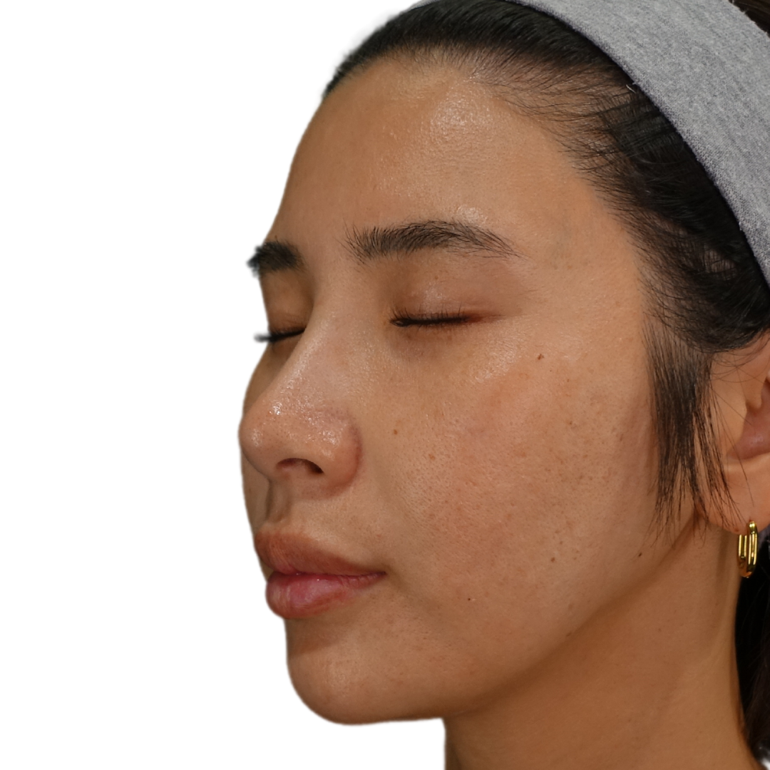 TCAクロス（クレーター治療）