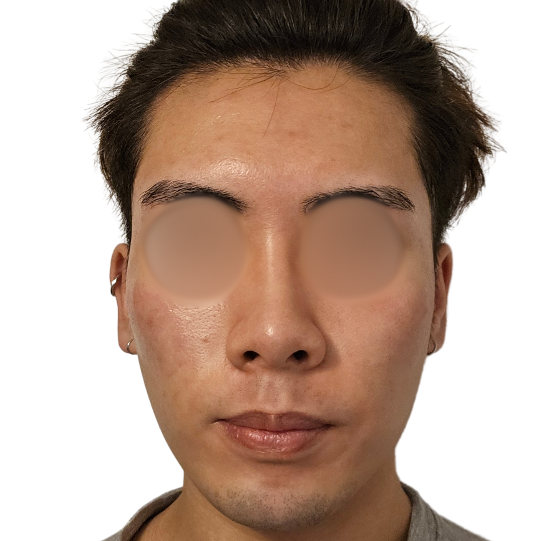 スキンボトックス