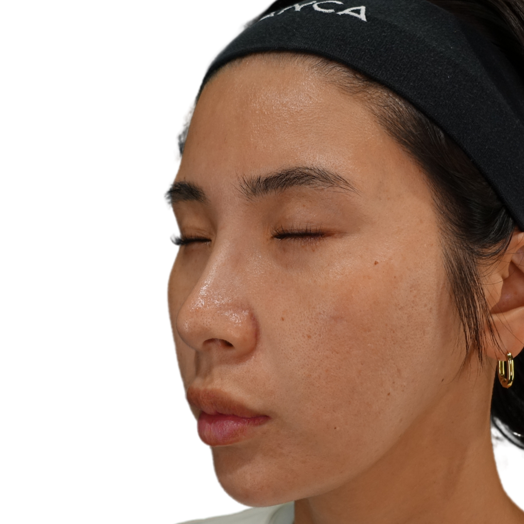 TCAクロス（クレーター治療）