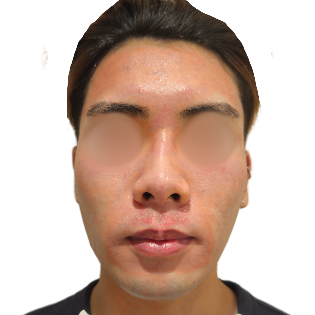 スキンボトックス