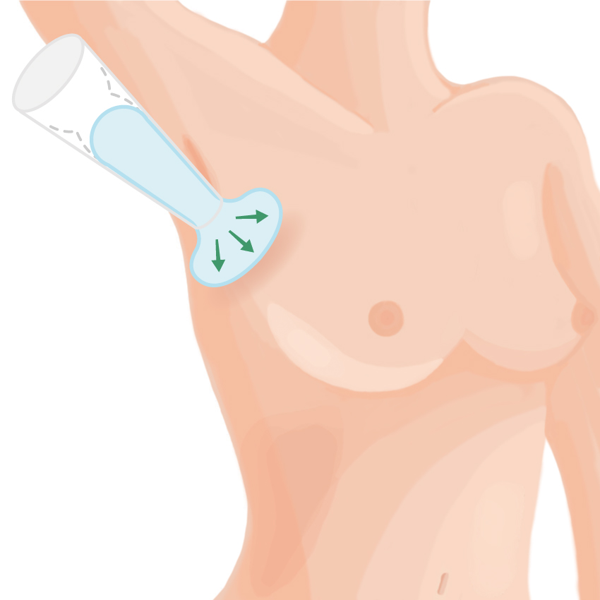 シリコンバッグ豊胸