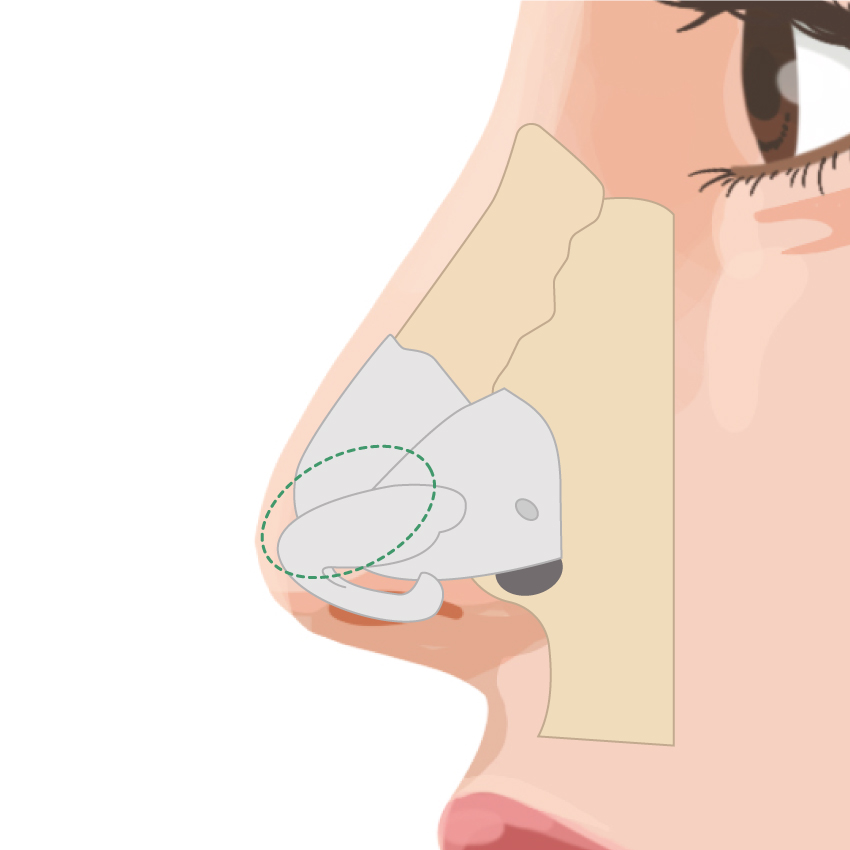 鼻中隔延長 ビアンカ銀座｜日本を代表する美容健康再生医療のクリニック