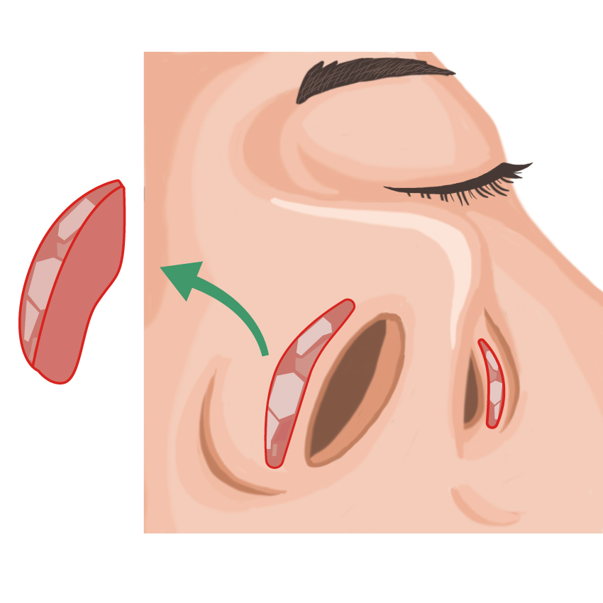 鼻孔縁挙上 ビアンカ銀座｜日本を代表する美容健康再生医療のクリニック