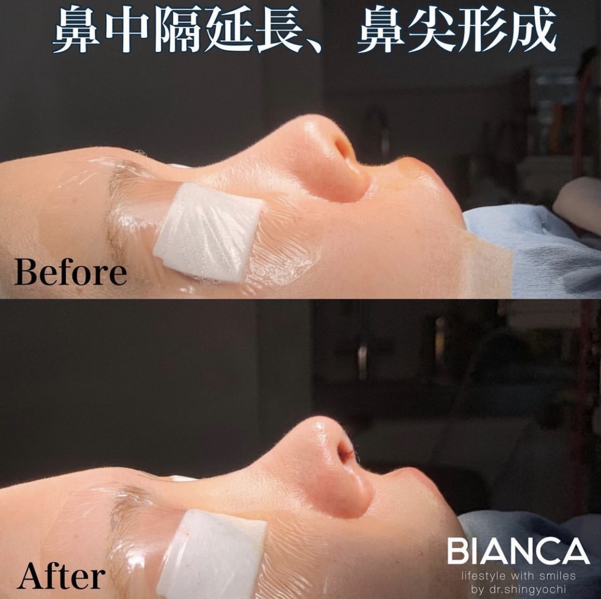 鼻中隔延長・鼻尖形成
