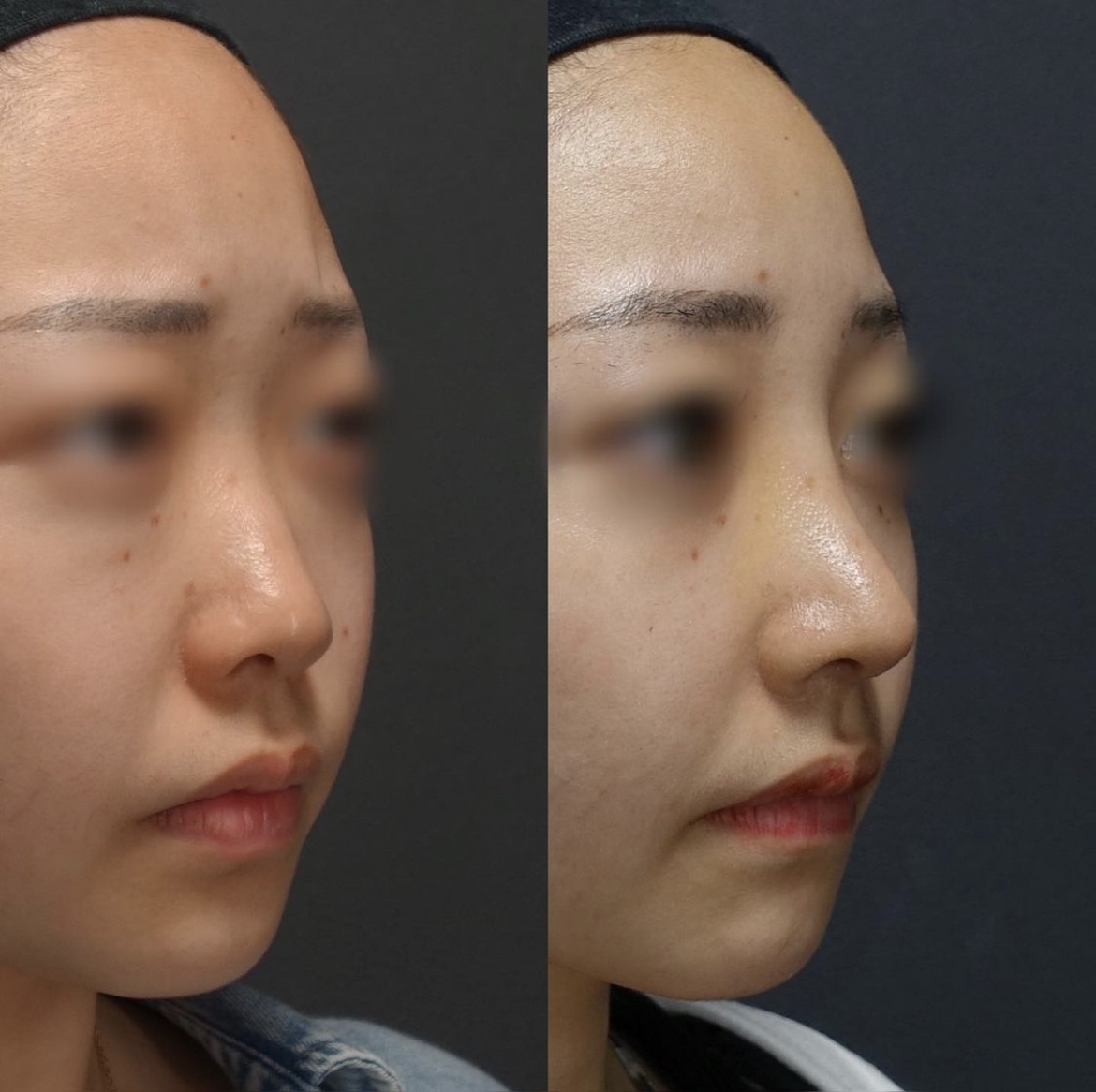 鼻中隔延長術・鼻尖形成・シリコンプロテーゼ