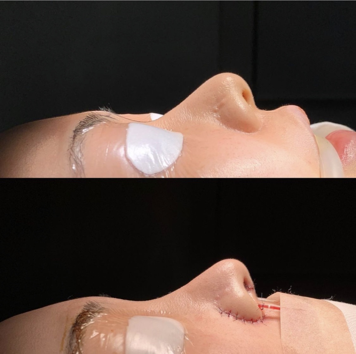 鼻中隔延長・鼻尖形成