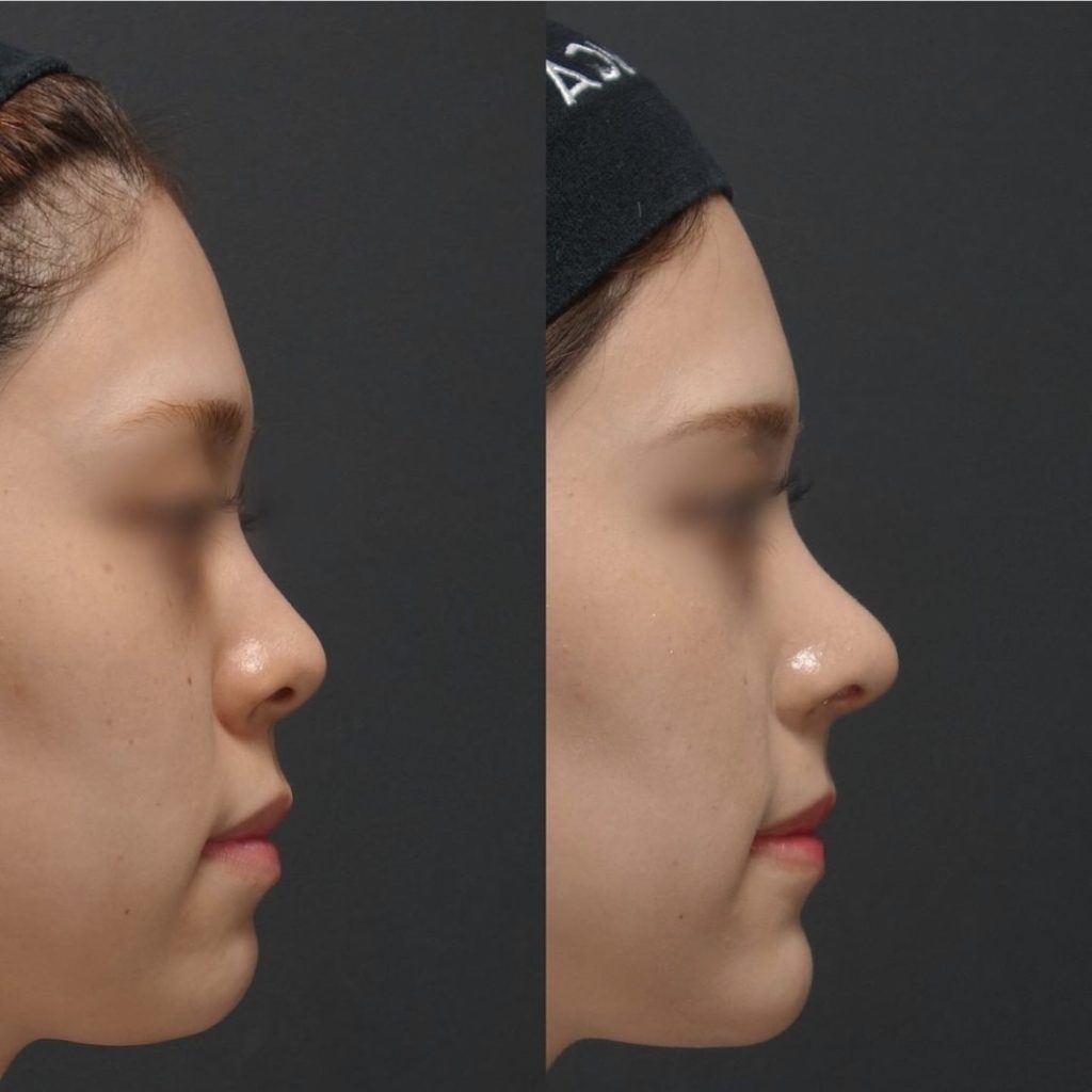 鼻中隔延長・鼻尖形成