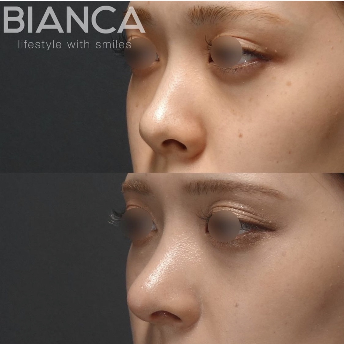 鼻中隔延長・鼻尖形成