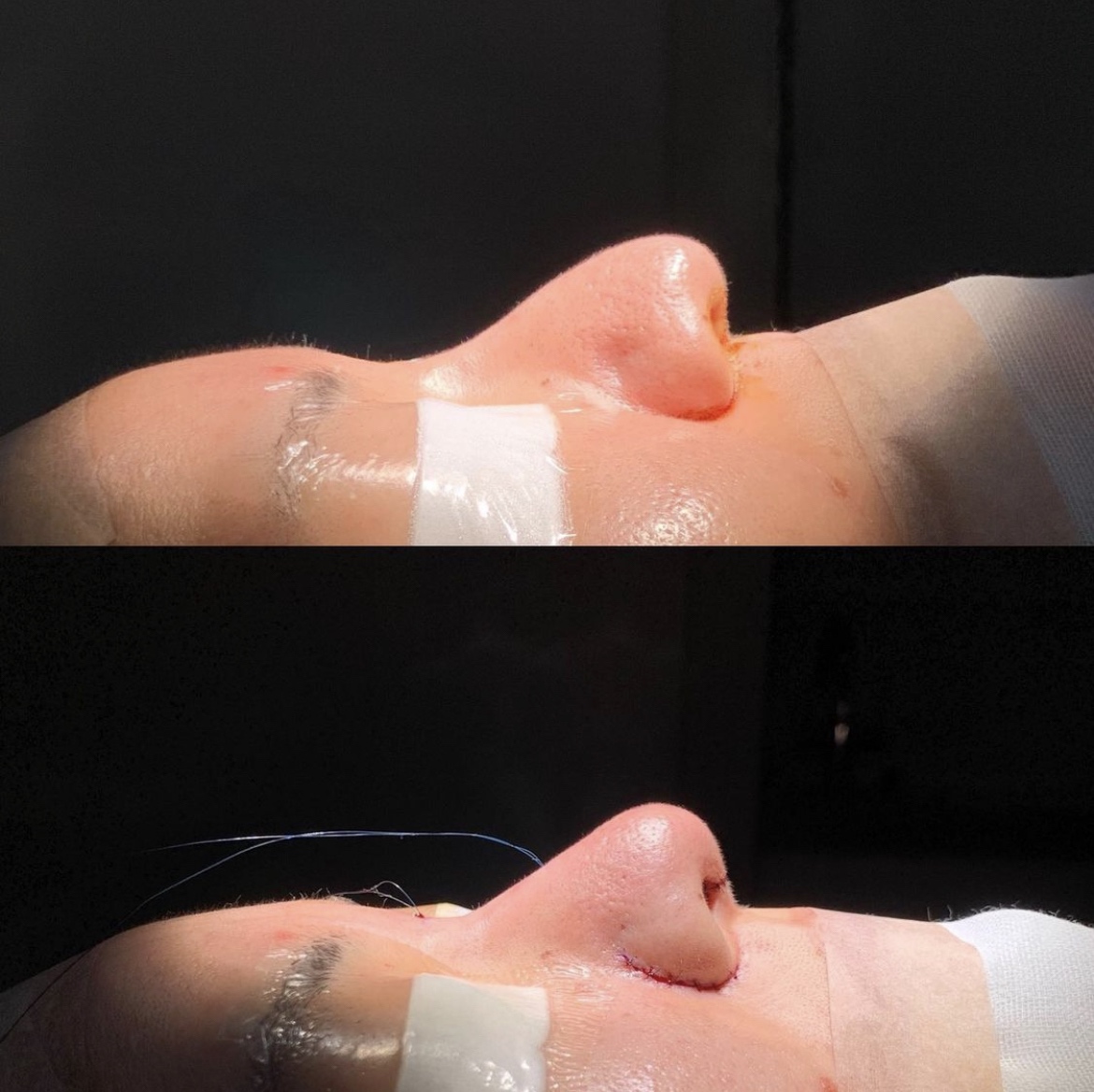 鼻中隔延長・鼻尖形成・鼻プロテーゼ挿入