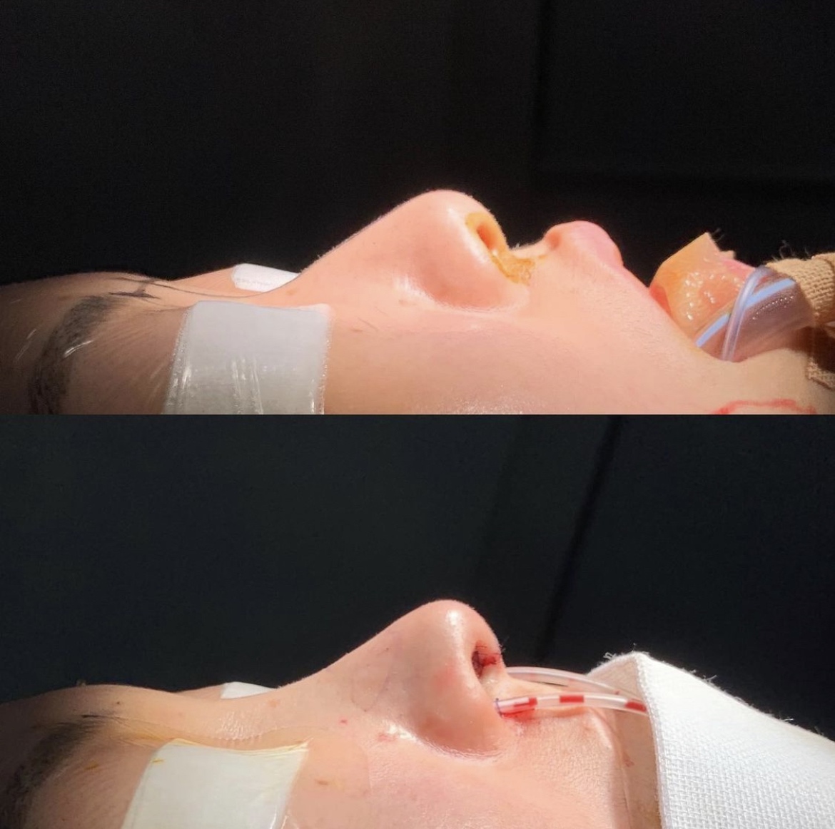 鼻中隔延長・鼻尖形成・鼻プロテーゼ挿入