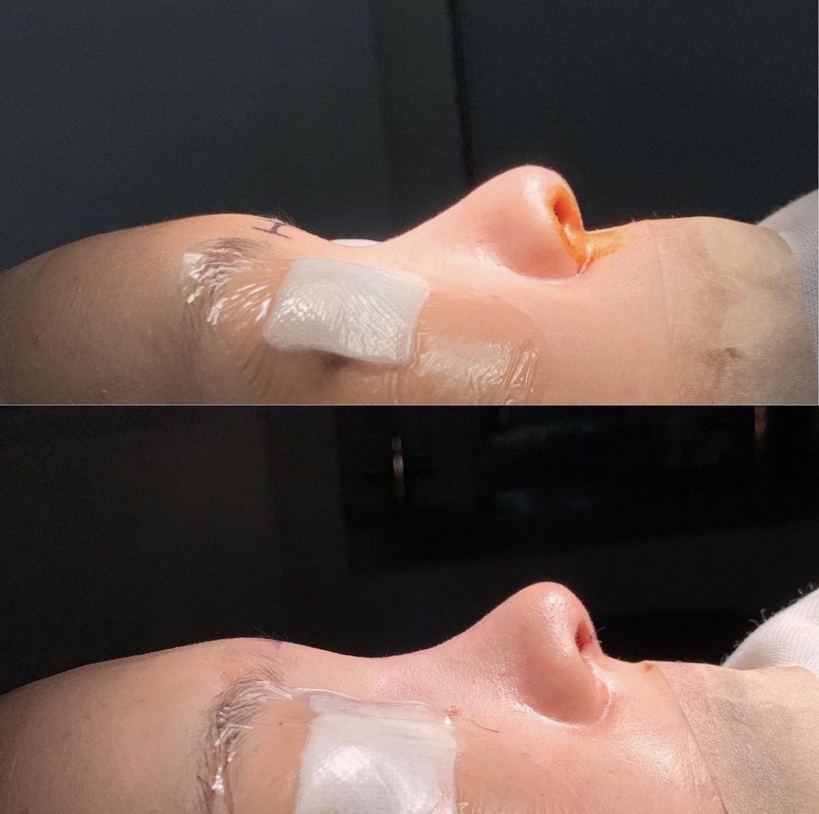 鼻中隔延長・鼻尖形成