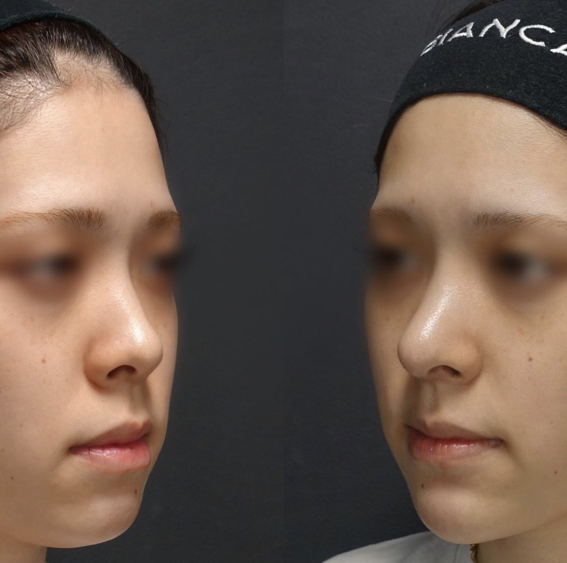 鼻中隔延長・鼻尖形成