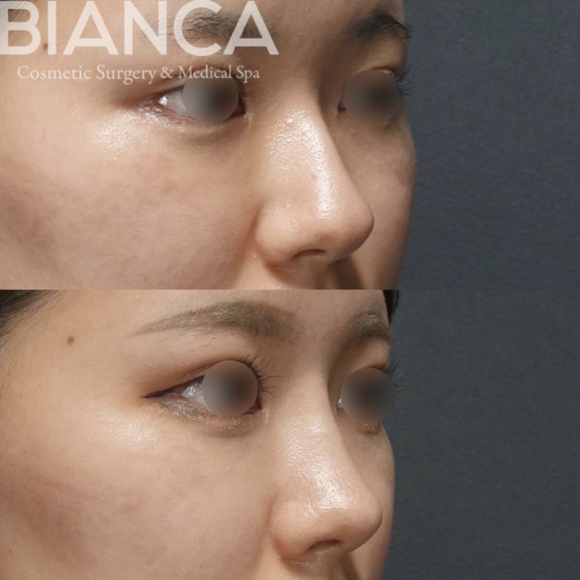 鼻骨骨切り・鼻中隔延長・鼻尖形成