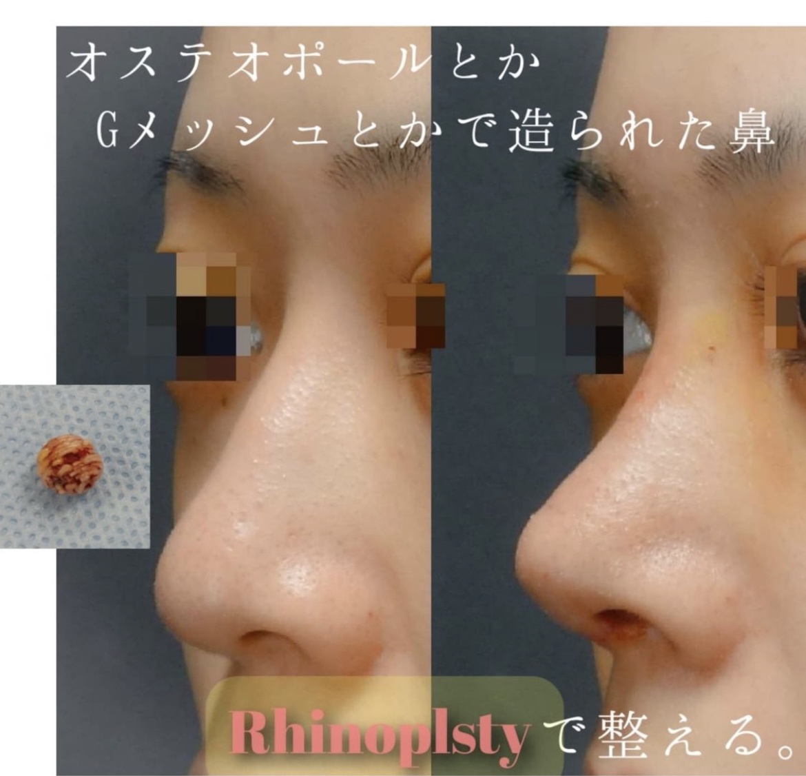 鼻骨骨切り・鼻中隔延長・鼻尖形成