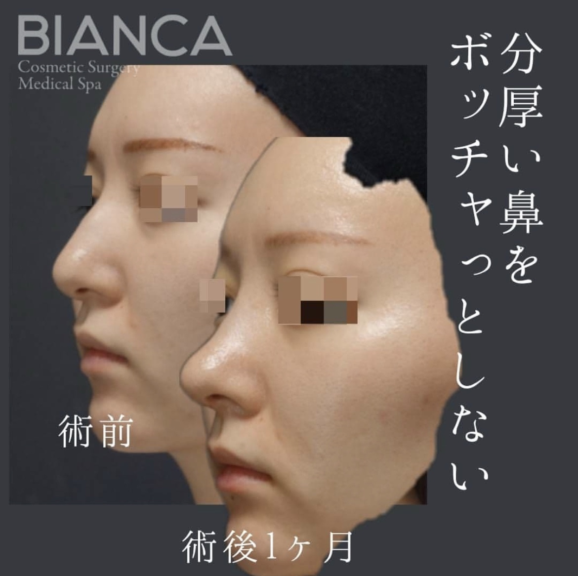 鼻骨骨切り・ハンプ切除 ・鼻中隔延長・鼻尖形成・鼻翼縮小