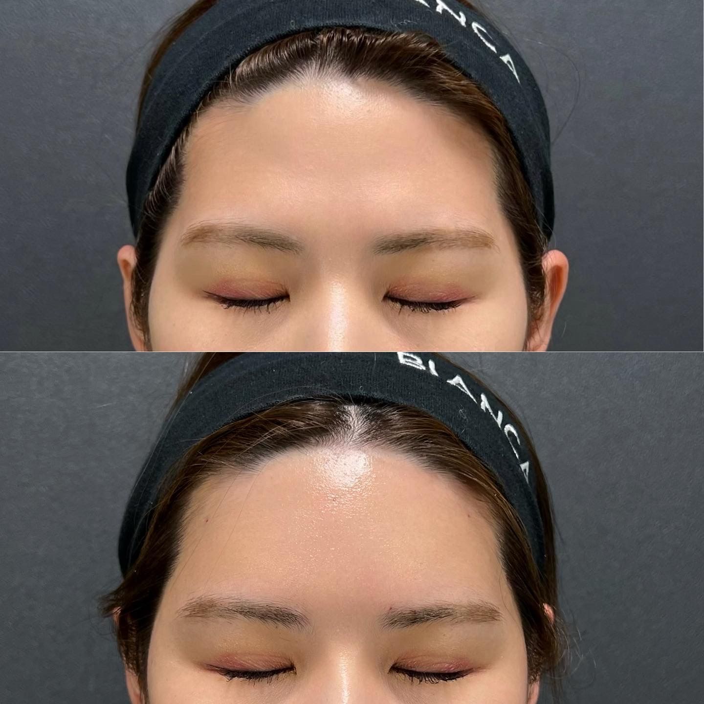 ヒアルロン酸（額）