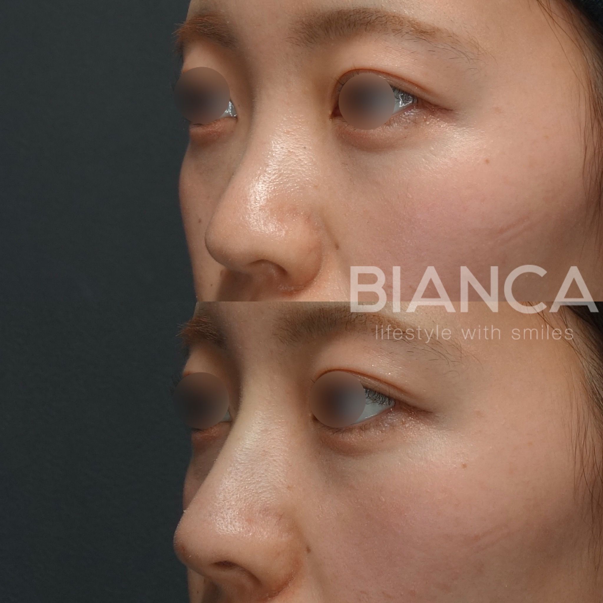 ヒアルロン酸注入