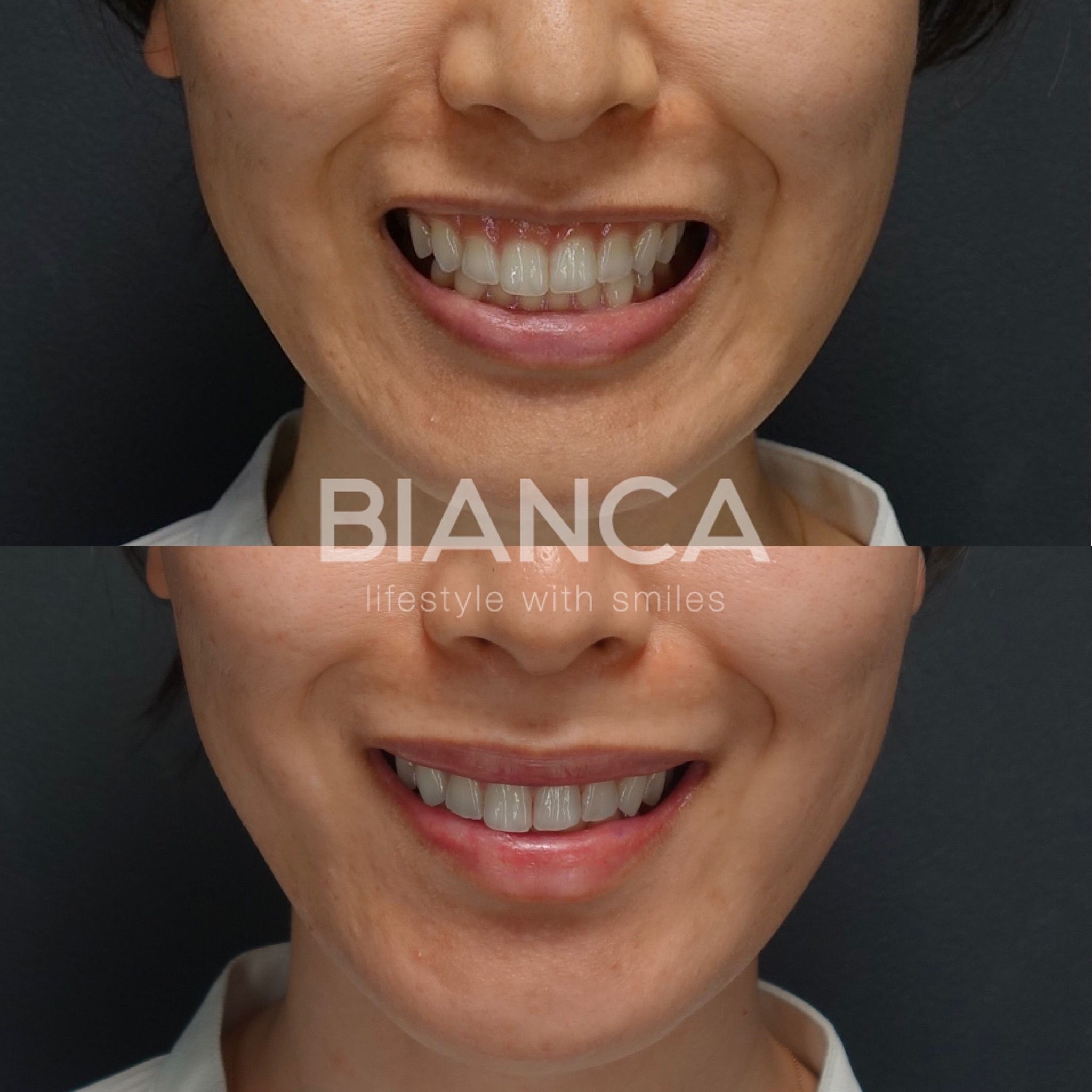 ガミースマイル