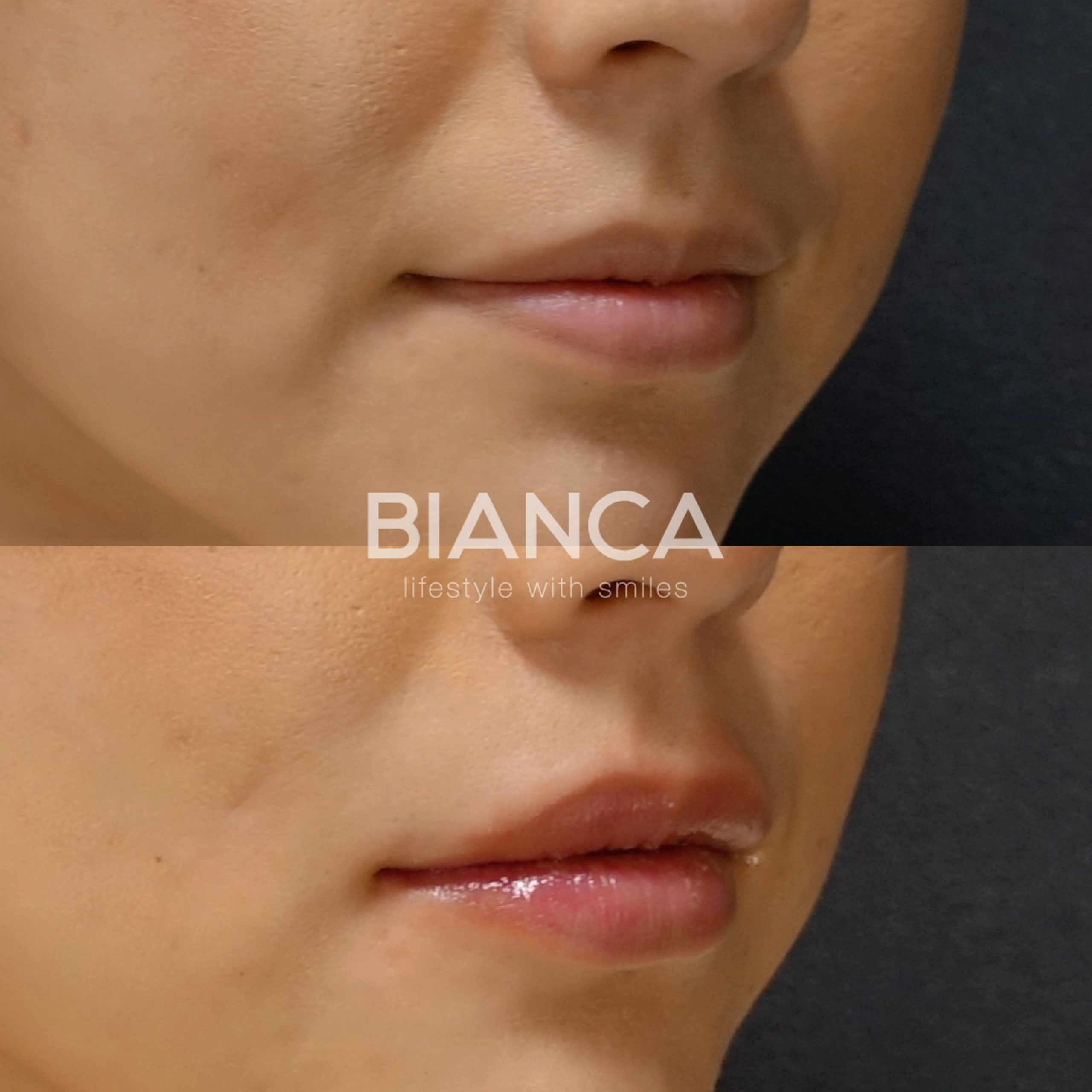 ヒアルロン酸（唇）