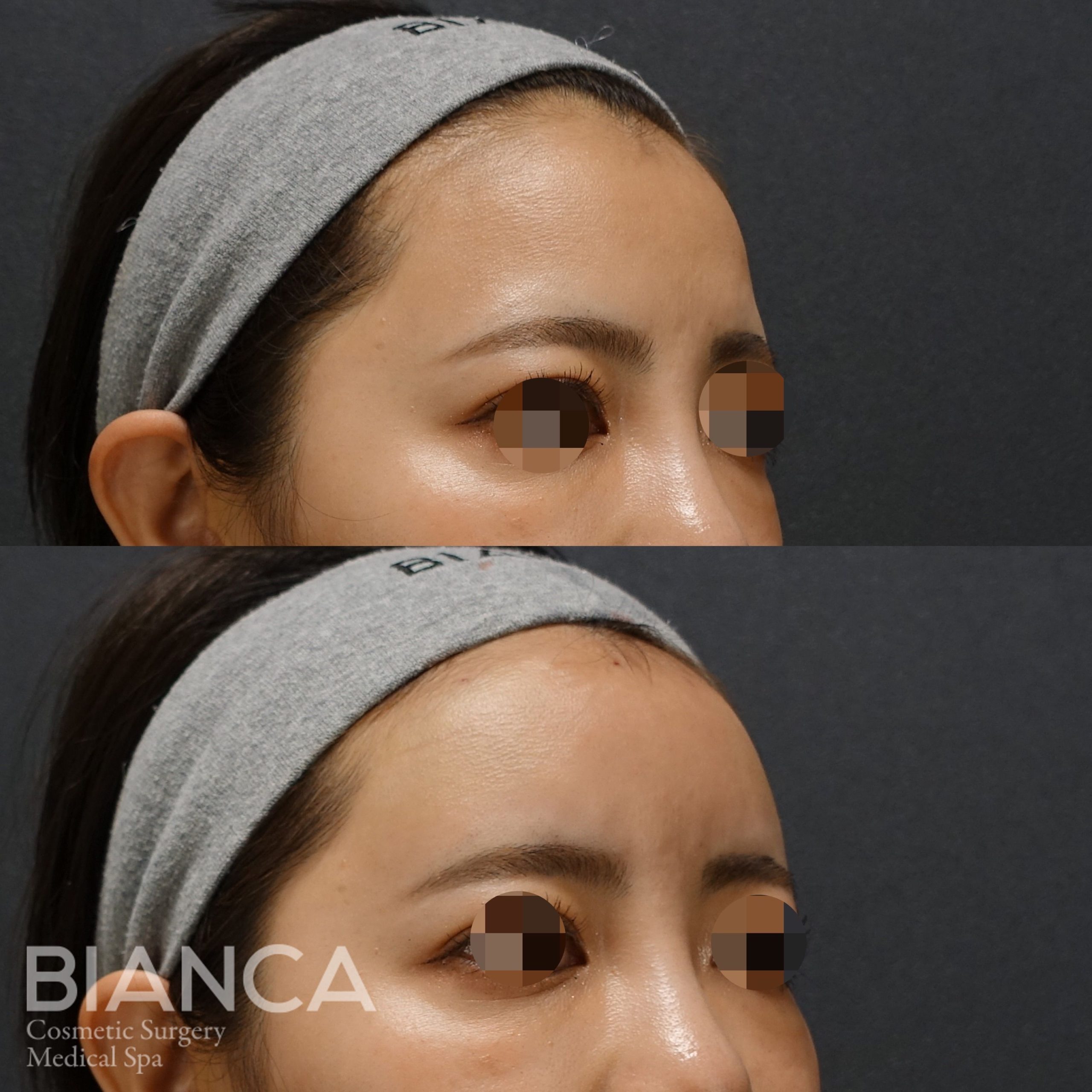 ヒアルロン酸（額）