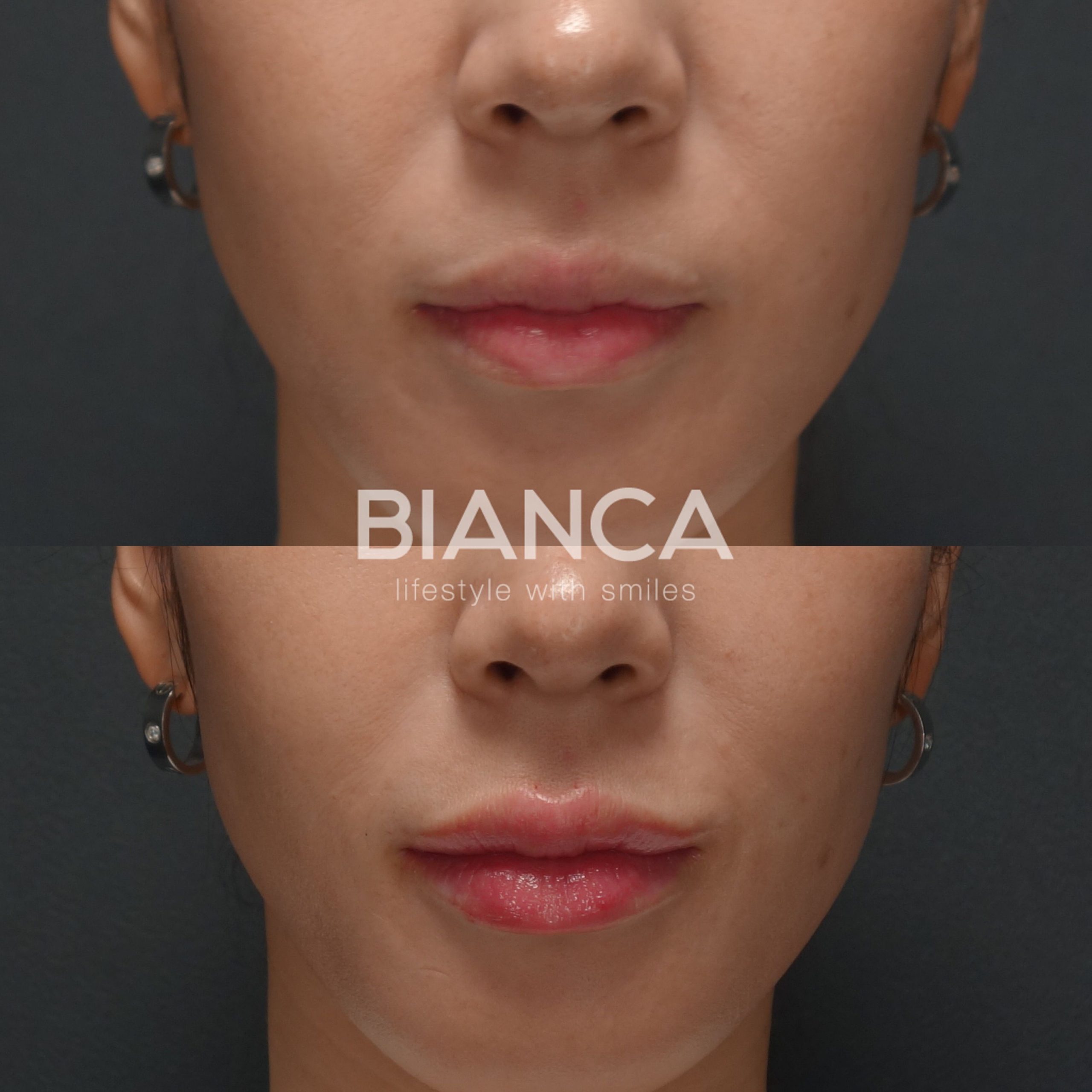 ヒアルロン酸（唇）