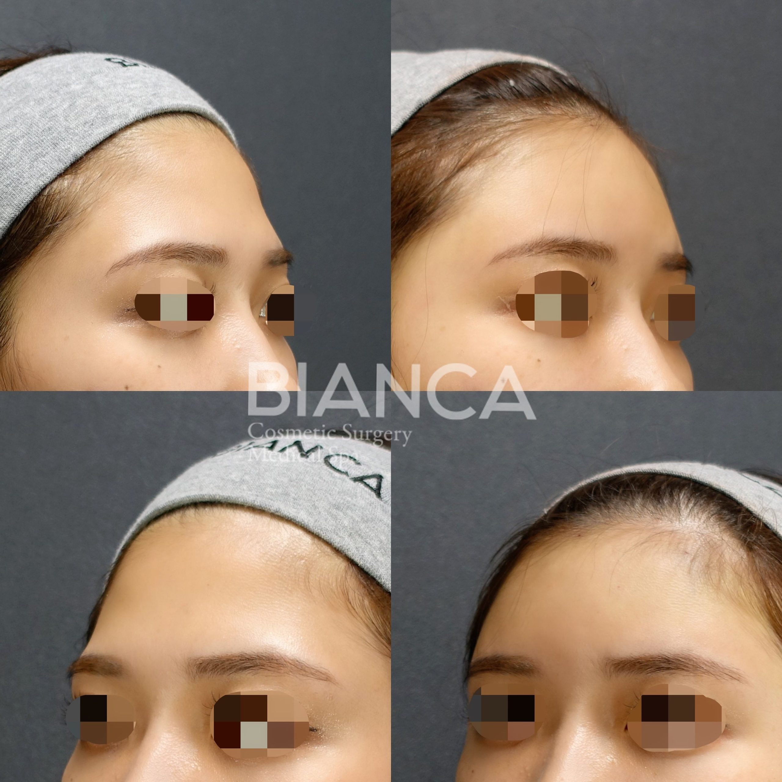 ヒアルロン酸（額）