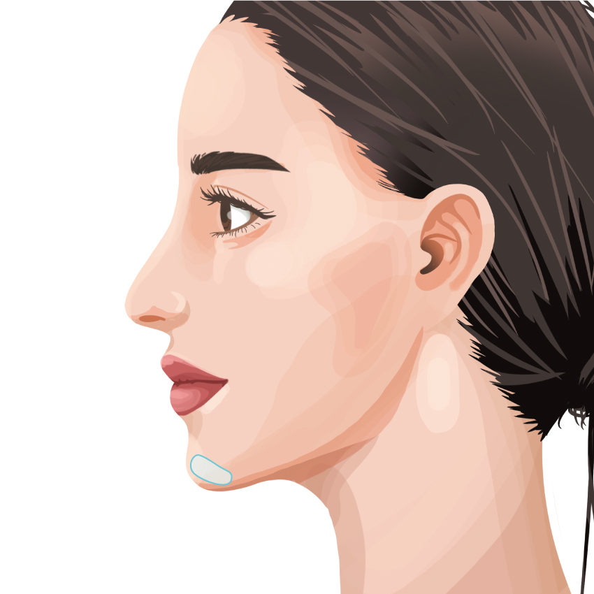 下顎プロテーゼ