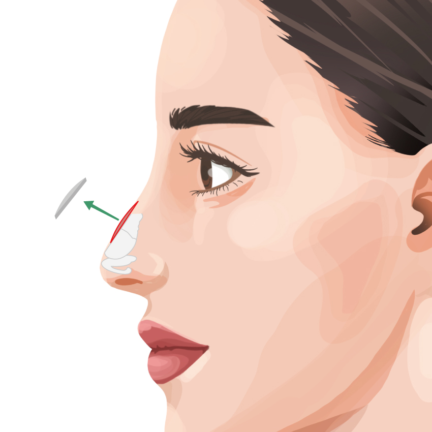 鷲鼻（わし鼻）修正・ハンプ切除