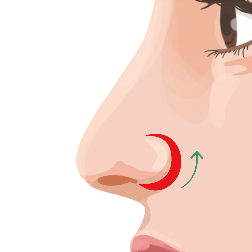 鼻翼挙上