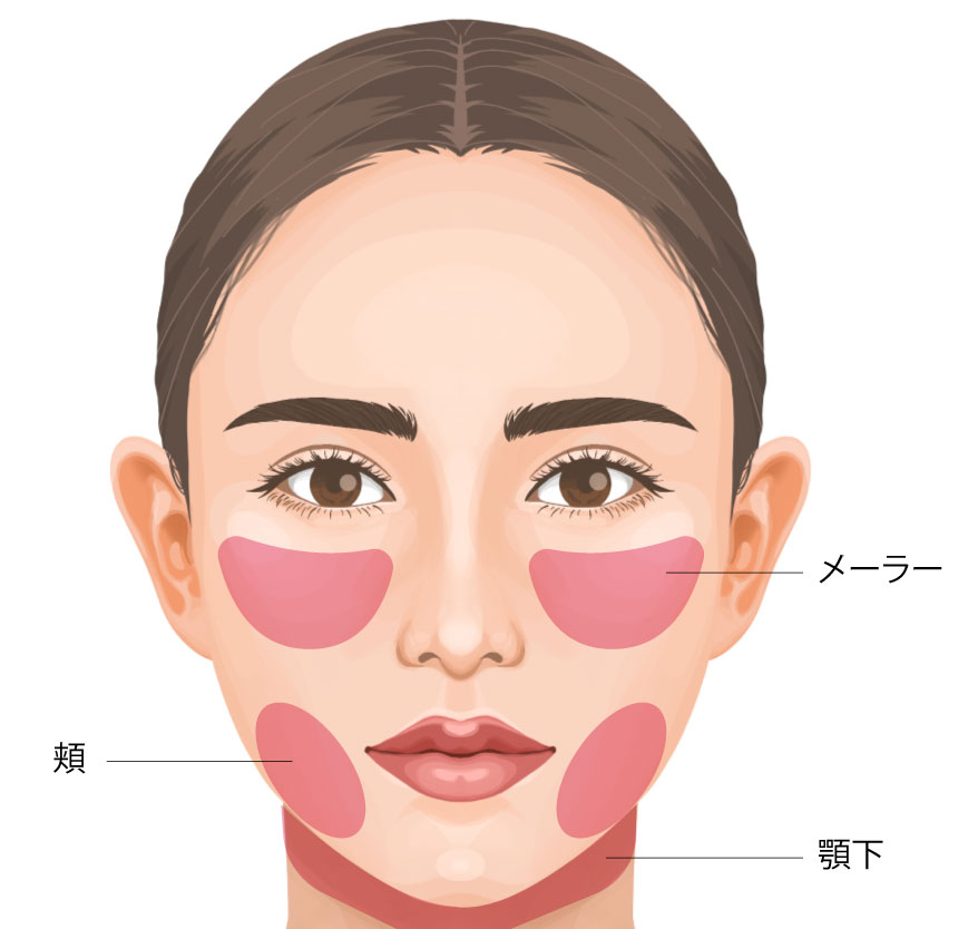トータルフェイスサクション（メーラー／頬／顎下） ビアンカクリニック