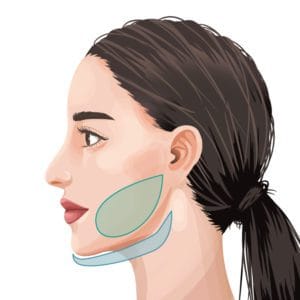 ベイザー(VASER)フェイスライン脂肪吸引のシェーマ画像