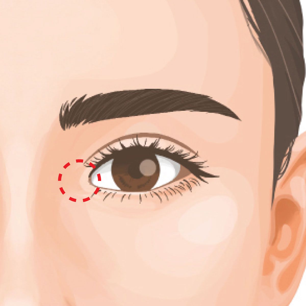 蒙古襞形成（目頭切開修正）