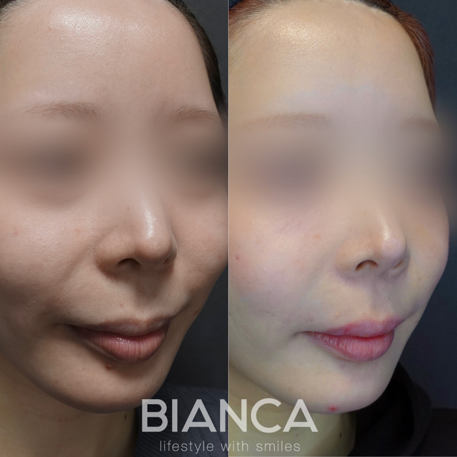 鼻翼基部プロテーゼ（貴族手術）