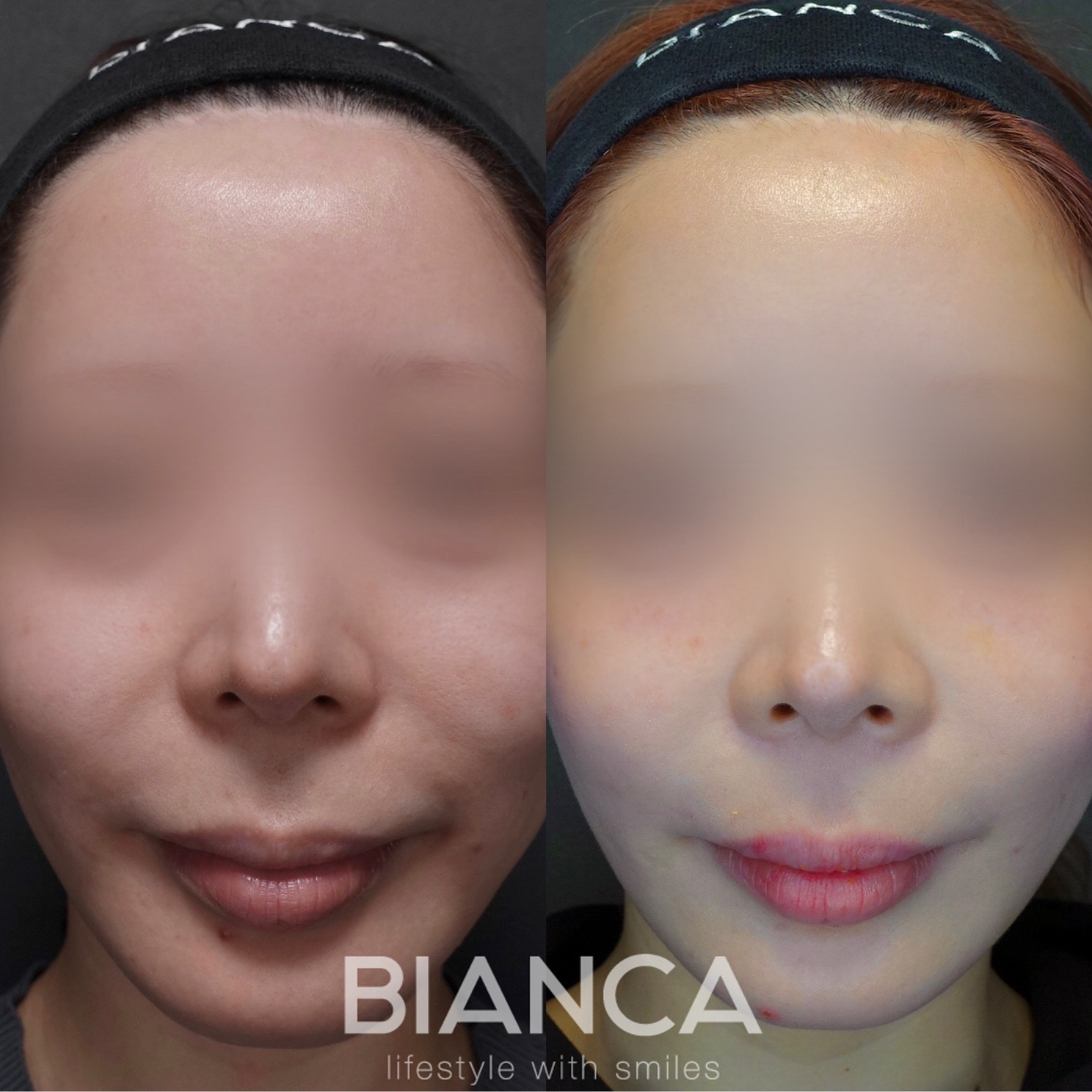 鼻翼基部プロテーゼ（貴族手術）