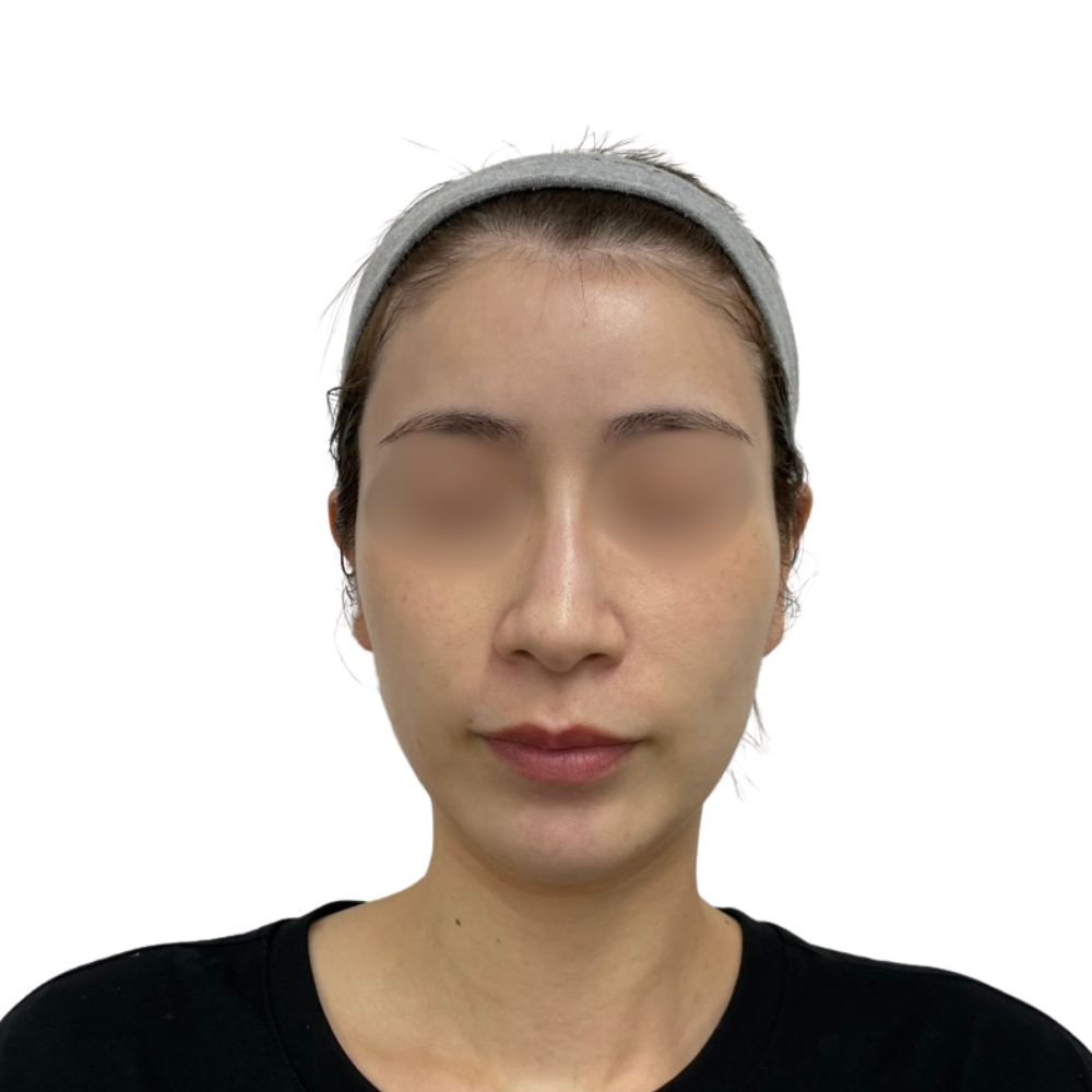 ハイフ/ウルトラセルZi